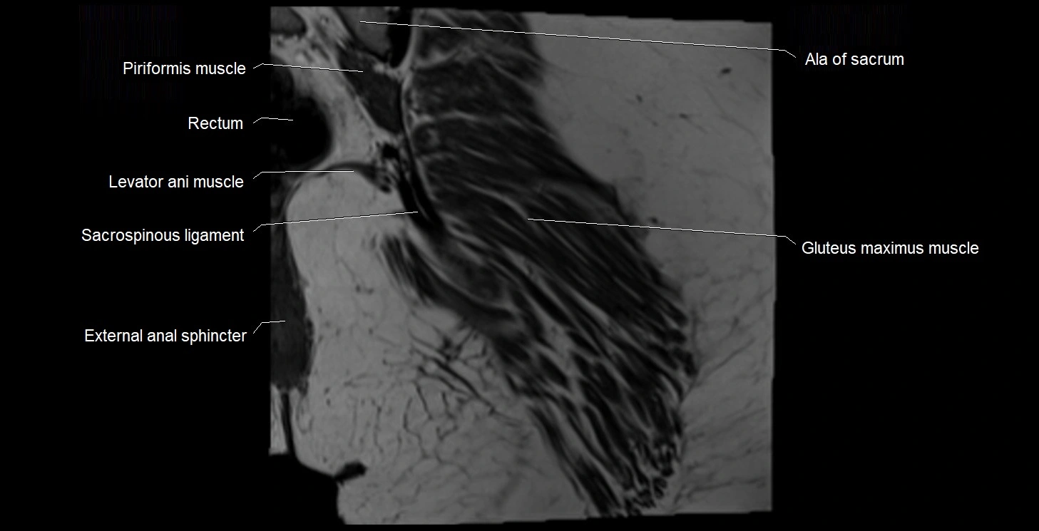 MRI Hip 3T coronal cross sectional anatomy image 58.webp